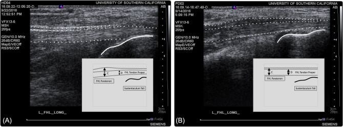 Long-axis ultrasound comparison of healthy flexor hallucis longus tendon and symptomatic tendinopathy in a dancer