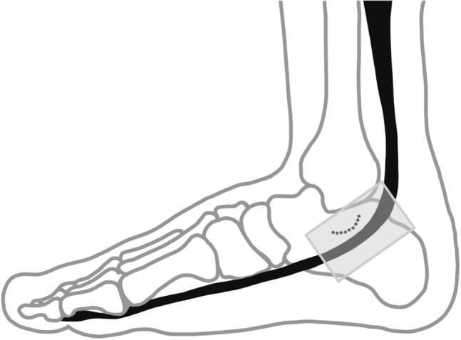 Schematic medial ankle view showing longitudinal ultrasound probe placement over the flexor hallucis longus tendon