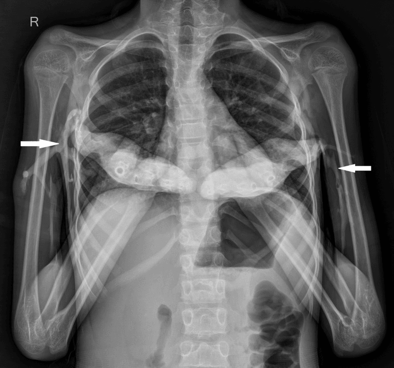 Chest radiograph showing axillary and chest-wall heterotopic ossification