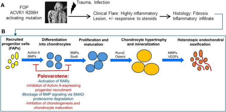 Sequence from inflammatory flare to chondrogenesis and heterotopic bone in FOP
