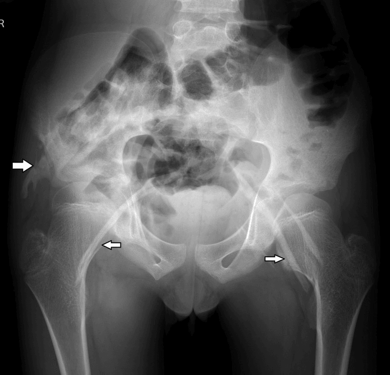 Pelvic radiograph showing short broad femoral necks and bridging heterotopic bone
