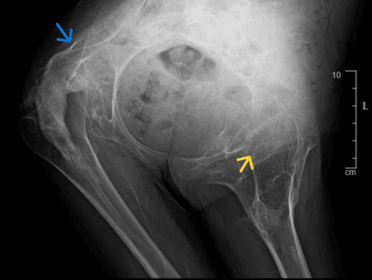 Pelvic radiograph showing periarticular heterotopic ossification around the hip
