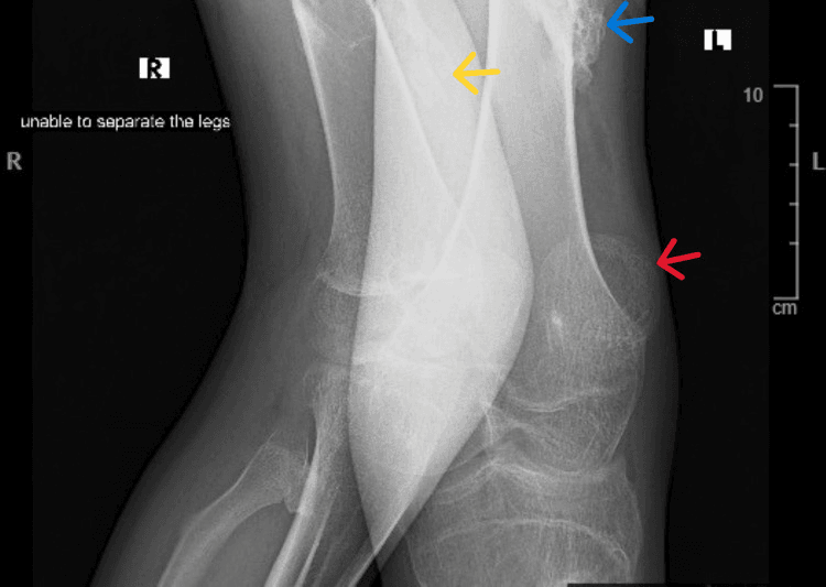 Knee radiograph showing sheet-like mature heterotopic ossification
