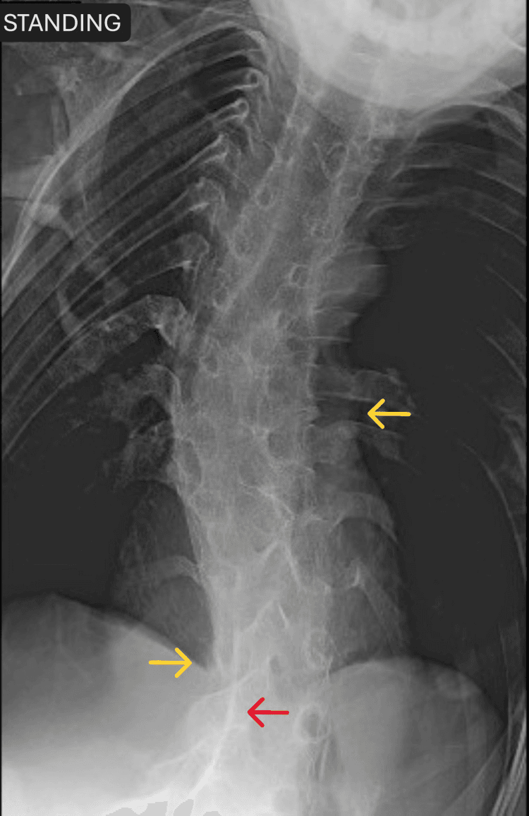 Spinal radiograph showing bridging heterotopic ossification and kyphoscoliosis