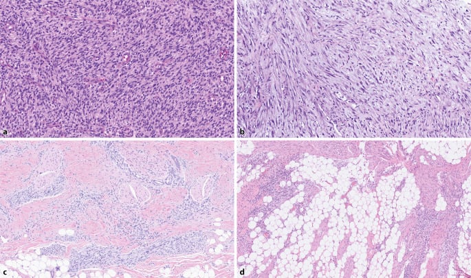 Four H&E panels (a-d) of infantile fibrosarcoma with ETV6-NTRK3 fusion: monomorphic spindle cells in sheets and vague fascicles, and tumour among fat