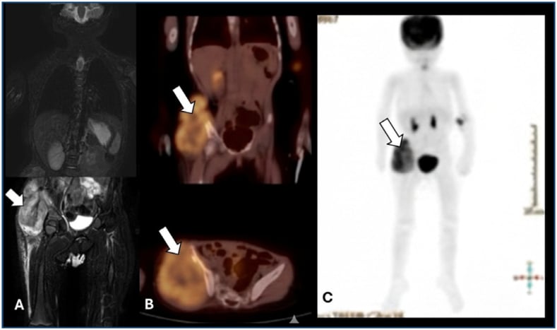 Infantile fibrosarcoma: hypermetabolic right hemipelvic soft-tissue mass (arrows) on coronal whole-body MRI, coronal and axial PET-CT, and whole-body PET