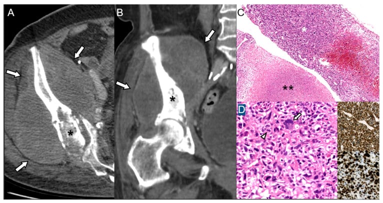 Post-radiation sarcoma of the ilium: CT with a large soft-tissue mass (arrows) and iliac destruction (asterisk), histology and immunostains