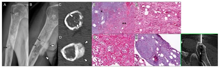 Dedifferentiated chondrosarcoma: radiographs and axial CT of a destructive lesion, histology, and a needle in the bone on CT