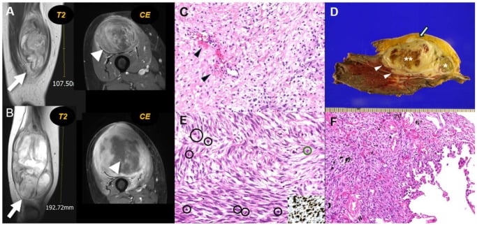 Adult extraskeletal fibrosarcoma: T2 and contrast-enhanced MRI at two time points (printed lengths 107.50 mm and 192.72 mm), histology and gross specimen