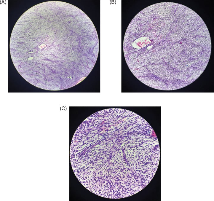 Three microscopic fields (A-C) of renal fibrosarcoma: spindle cells in intersecting bundles within collagenous stroma