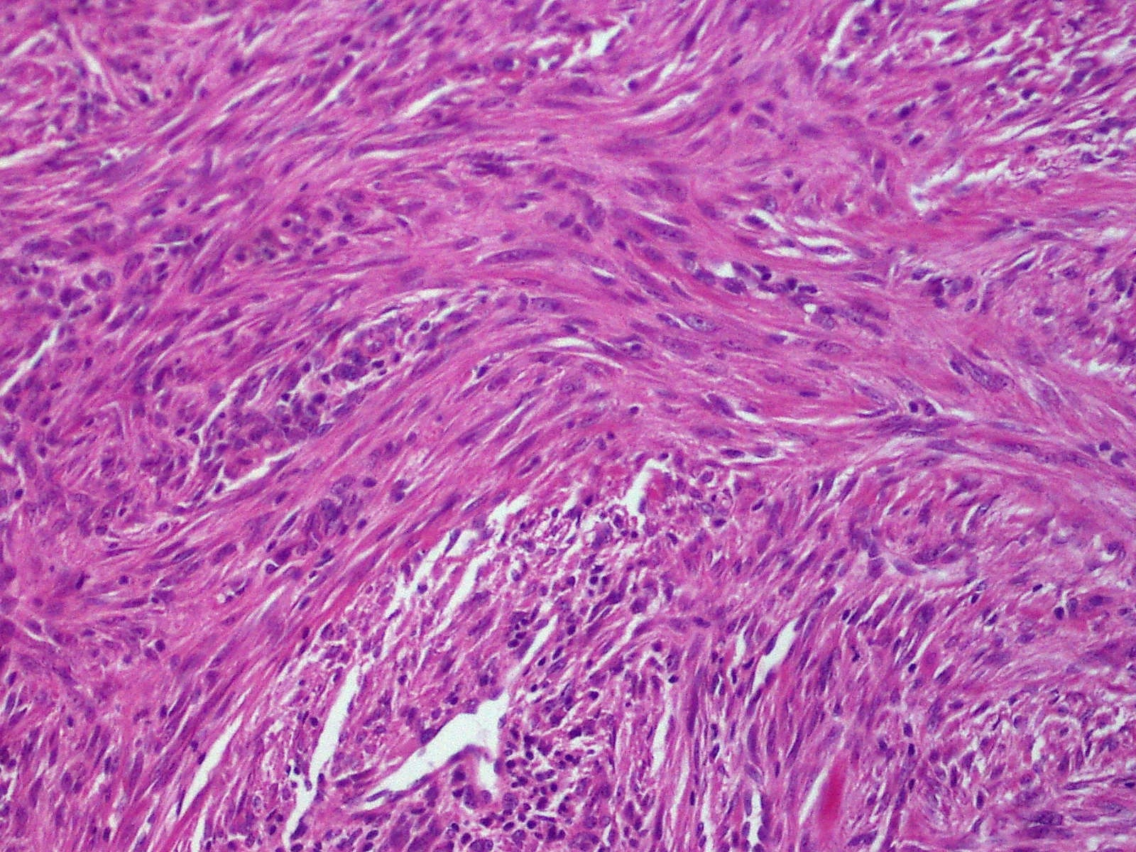 Histology of fibrosarcoma showing intersecting fascicles of spindle cells in a classic herringbone pattern, producing collagen without osteoid or chondroid matrix.