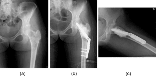 Proximal femur fibrous dysplasia with shepherd's crook deformity and surgical treatment