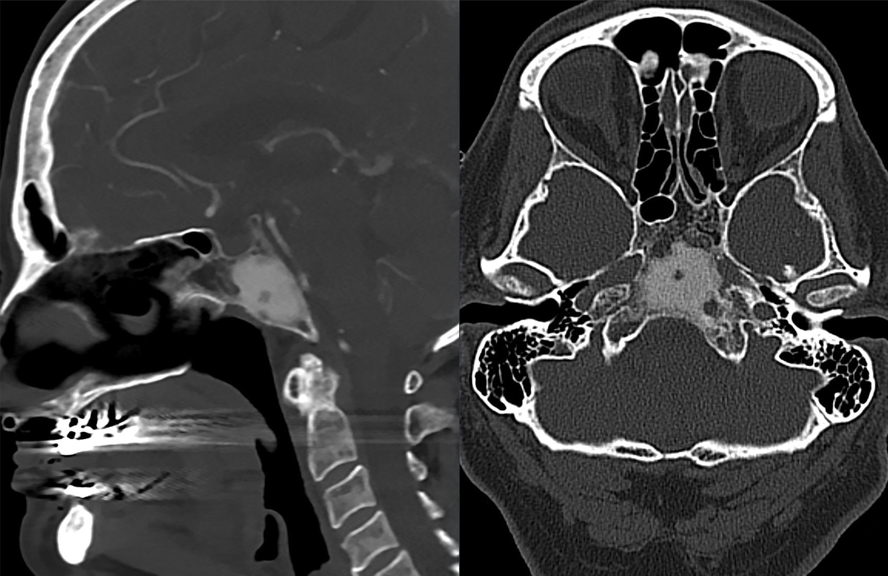 Bone-window CT in sagittal and axial views showing clival fibrous dysplasia with ground-glass density.