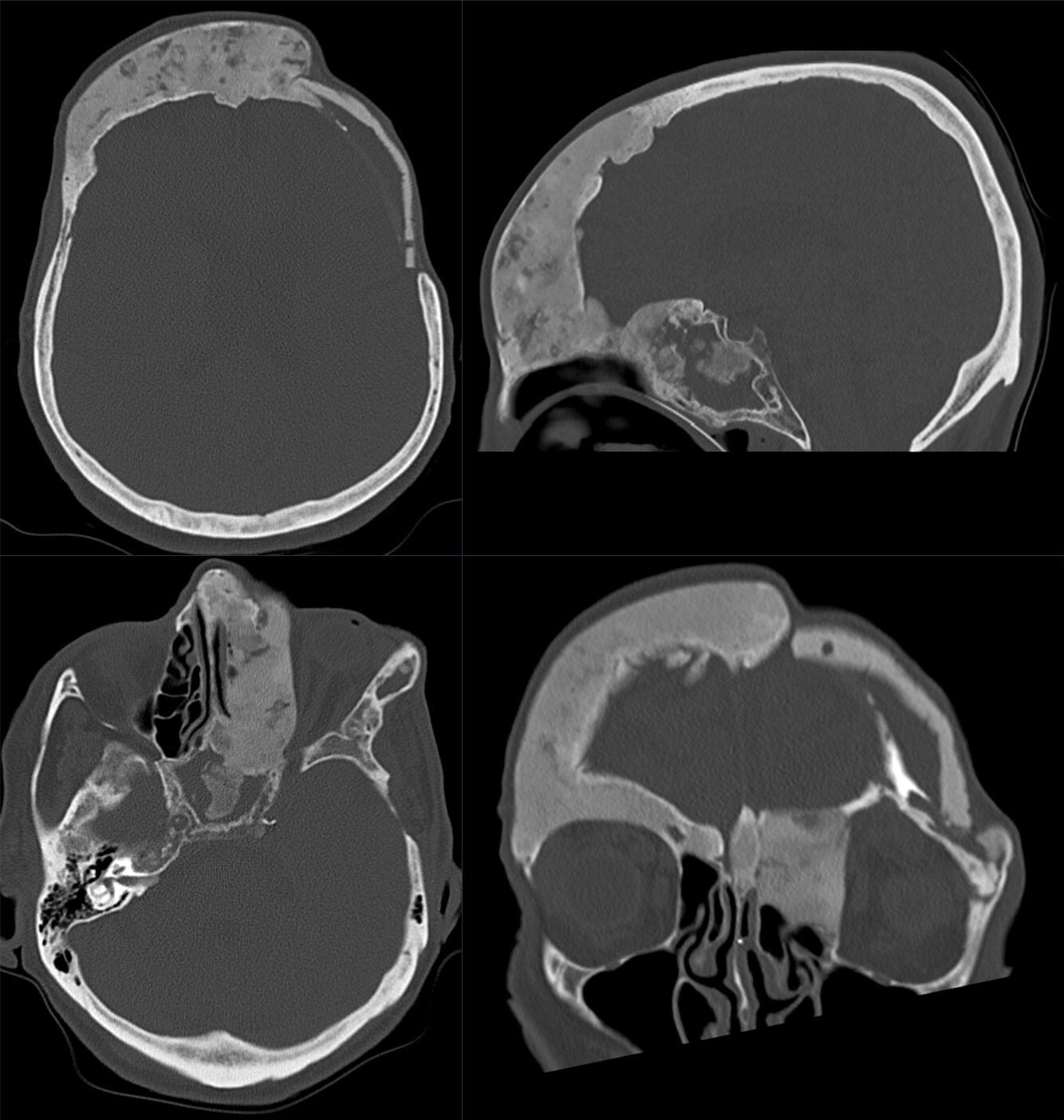 Four-panel bone-window CT montage showing extensive craniofacial fibrous dysplasia involving the calvarium, skull base and facial bones.