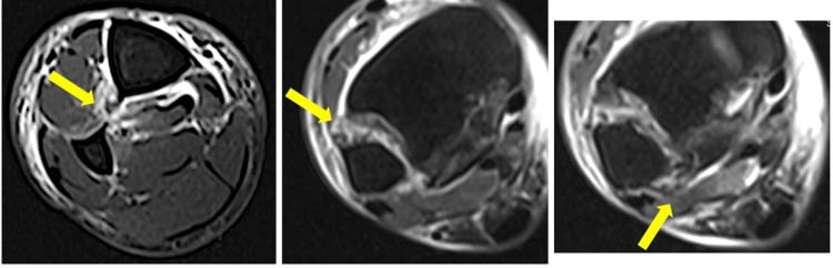 Three axial STIR MRI images from a Maisonneuve fracture, one arrow in each: at the interosseous membrane injury, the anterior inferior tibiofibular ligament and the posterior inferior tibiofibular ligament