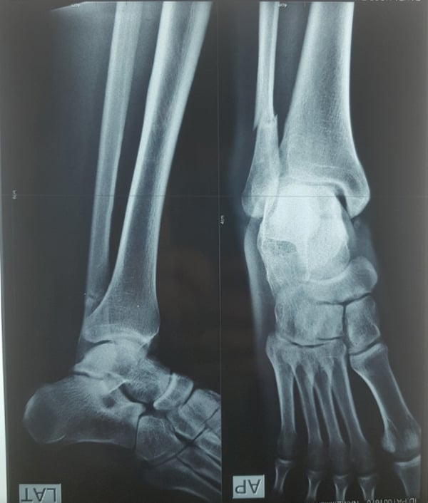 Lateral and AP radiographs, labelled LAT and AP, showing a minimally displaced transverse distal-third fibular stress fracture