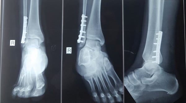 AP mortise and lateral radiographs after plate fixation of a symptomatic fibular stress fracture