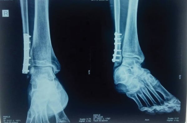 AP and oblique ankle radiographs, labelled on the films, four months after plate fixation of the fibular stress fracture