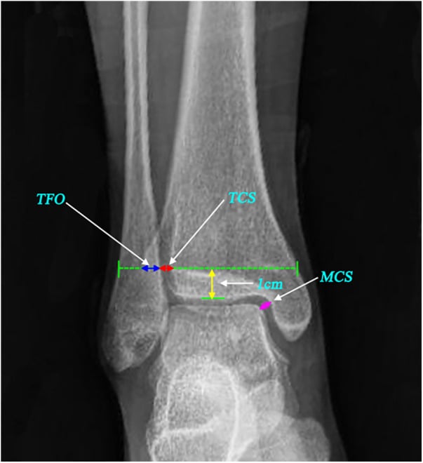 Ankle radiograph annotated with tibiofibular overlap (TFO), tibiofibular clear space (TCS) and medial clear space (MCS), with a line drawn 1 cm above the tibial plafond