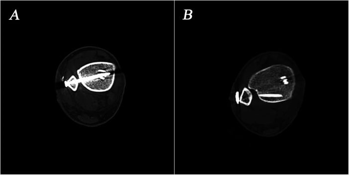 Axial CT comparing ideal and maldirected syndesmotic screw trajectories