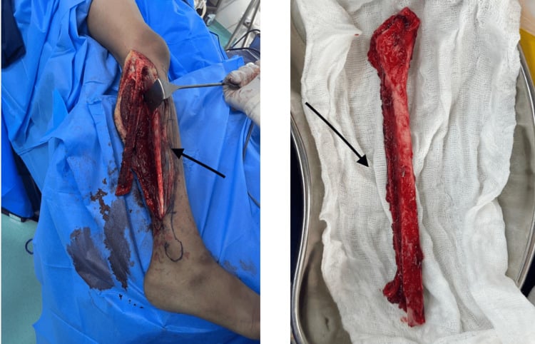 Operative view of a harvested vascularised fibular graft and its vascular pedicle