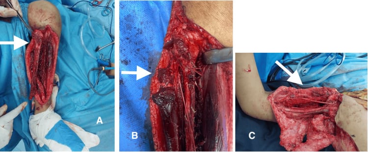 Operative donor and recipient views of a free vascularised fibula transfer