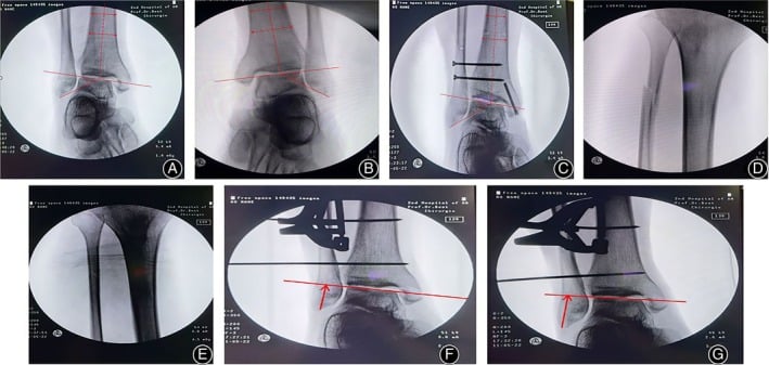 7-panel Maisonneuve fracture pre and post-operative fluoroscopy images