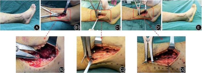 7-panel intraoperative surgical technique for Maisonneuve fracture reduction