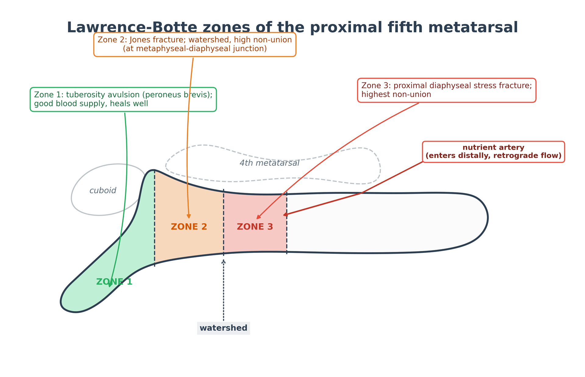 Diagram of the Lawrence-Botte three zones of the proximal fifth metatarsal with the watershed blood supply