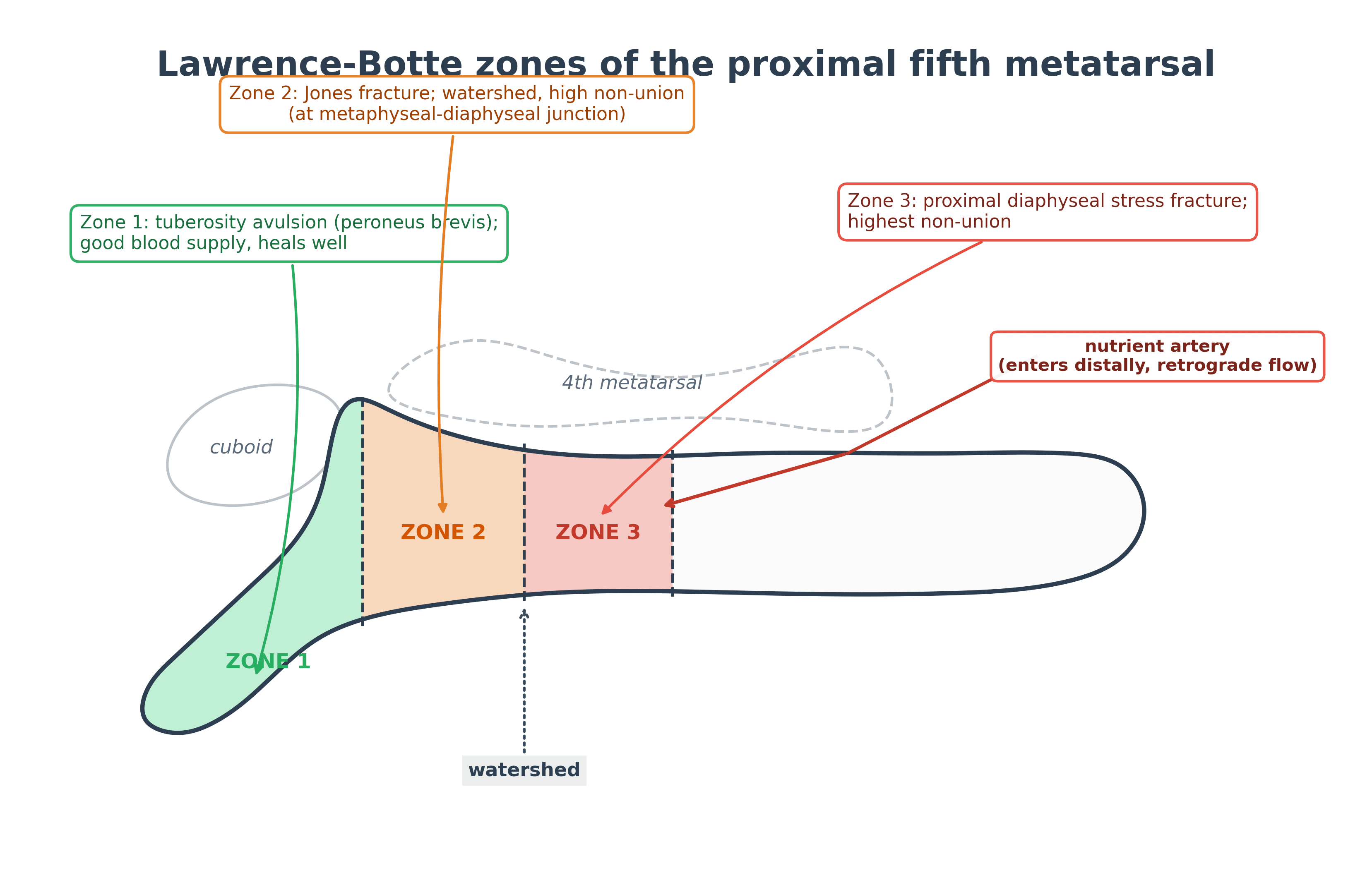 Diagram of the Lawrence-Botte three zones of the proximal fifth metatarsal with the watershed blood supply