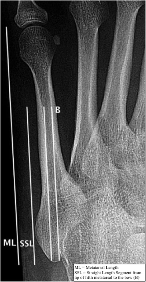 Anteroposterior radiograph demonstrating measurement of fifth metatarsal medullary canal diameter at the bow of the bone alongside metatarsal and straight length measurements