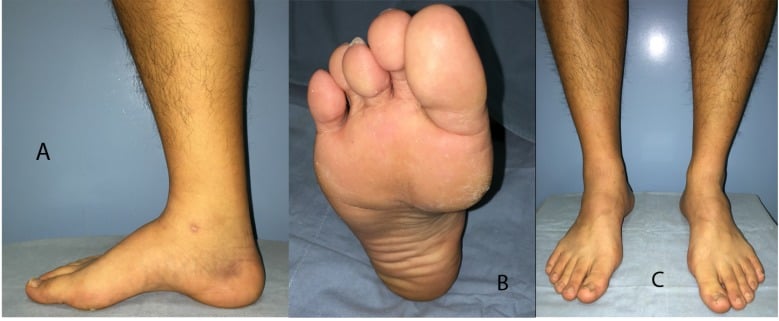 Clinical photographs of a cavus foot showing an elevated medial longitudinal arch, plantar callus under a depressed first metatarsal head and hindfoot alignment from behind