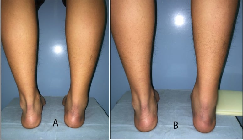 Posterior view of the heels showing right hindfoot varus which corrects when the Coleman block test is performed