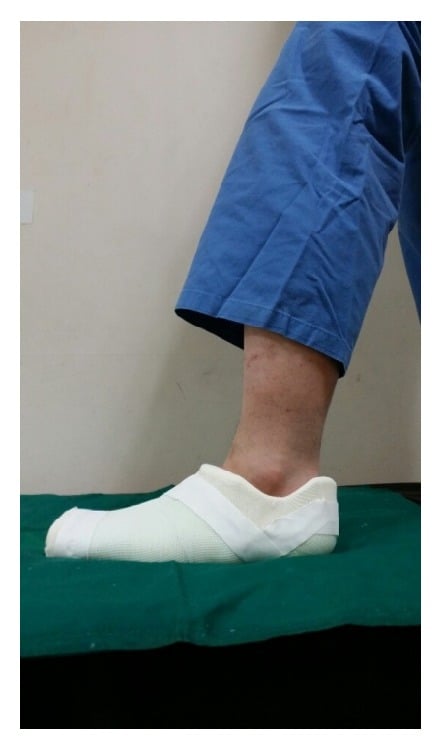 Lateral photograph of a short foot cast applied for a fifth metatarsal fracture