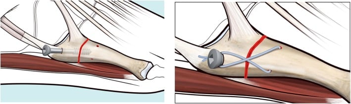Diagram of intramedullary screw position with a cerclage hole and the final construct in the fifth metatarsal