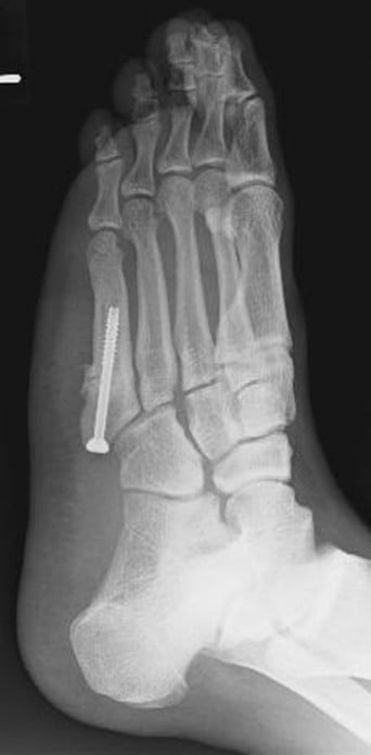 Radiograph immediately after curettage of the fracture site, insertion of a 5 mm cannulated cancellous screw and autologous bone grafting of the fifth metatarsal