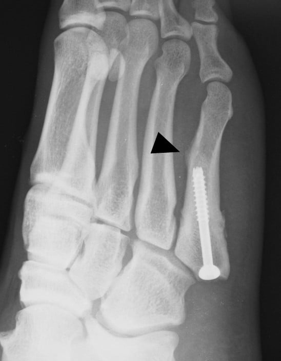 Radiograph showing a new stress fracture at the tip of an intramedullary screw with thickened dorsal cortex