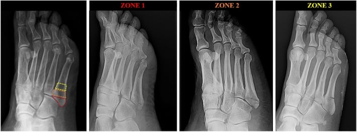 Radiographs demonstrating fractures in zone 1, zone 2 and zone 3 of the proximal fifth metatarsal against the anatomical landmarks