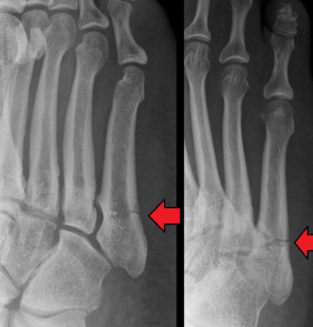 Radiograph showing Jones fracture of the fifth metatarsal at the metaphyseal-diaphyseal junction