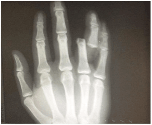 Dorsopalmar hand radiograph showing an interphalangeal joint dislocation