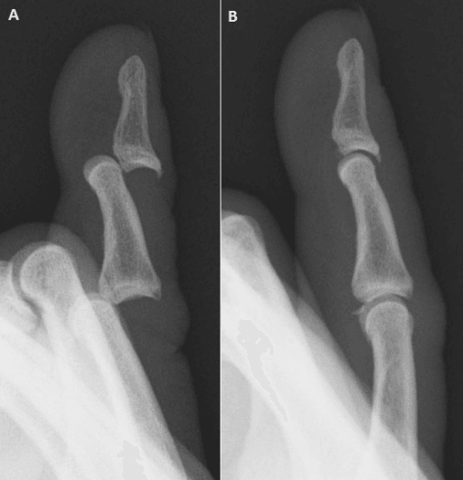Lateral radiographs of a finger with double interphalangeal dislocation before and after reduction