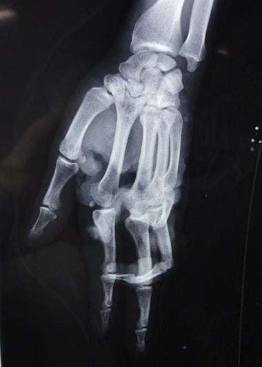 Radiograph of the right hand showing distal interphalangeal joint dislocation of the 5th finger