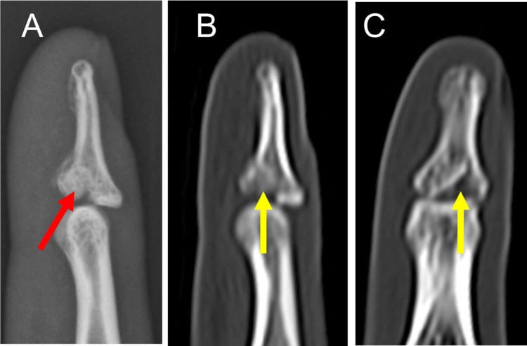 Radiograph and CT images of a DIP joint, arrows marking an articular fragment at the base of the distal phalanx