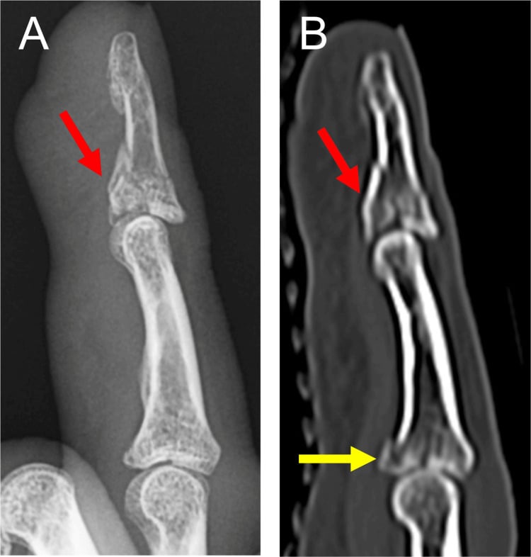 Lateral radiograph and sagittal CT showing simultaneous dorsal fracture-dislocations of the PIP and DIP joints