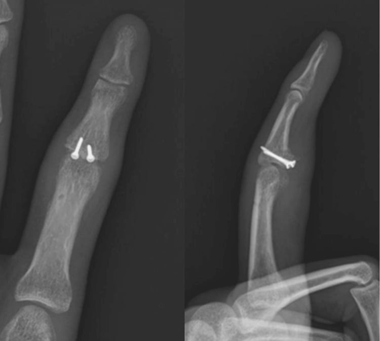Postoperative finger radiographs showing an incorporated hemi-hamate graft and congruent PIP joint