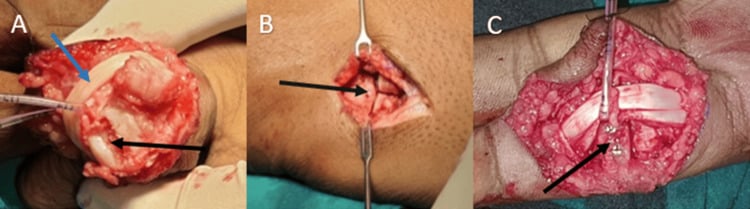 Three-panel operative sequence showing PIP shotgun exposure, hamate graft harvest and screw fixation of the graft