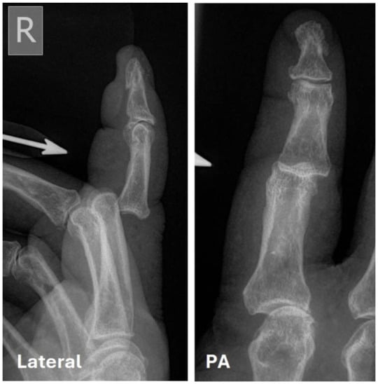 Lateral and PA radiographs from an open dorsal dislocation of the index-finger proximal interphalangeal joint