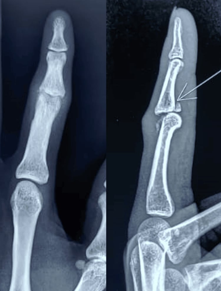 Frontal and lateral finger radiographs of a displaced intra-articular fracture of the middle-phalanx base, an arrow marking the fracture on the lateral view