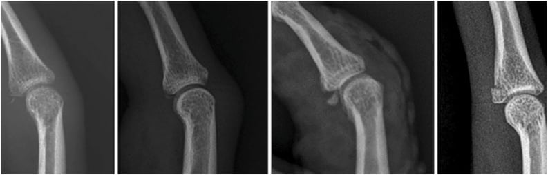 Lateral finger radiographs showing different shapes of volar plate avulsion fragment at the middle-phalanx base