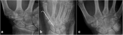 Radiographs of thumb basal joint osteoarthritis